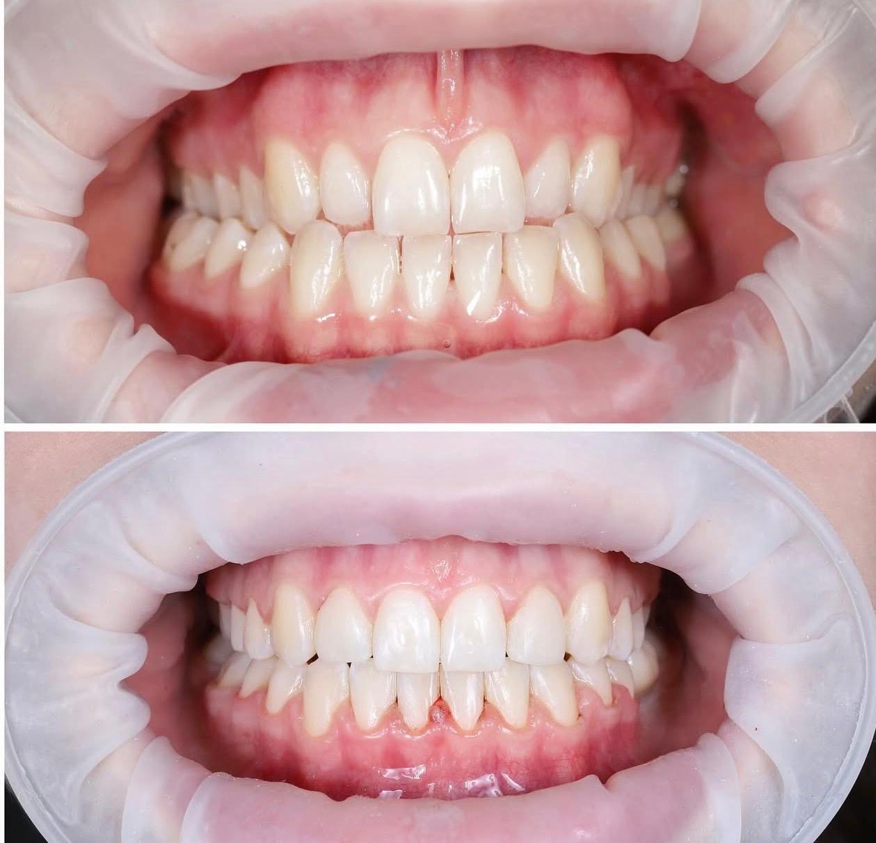 Antes e Depois 1