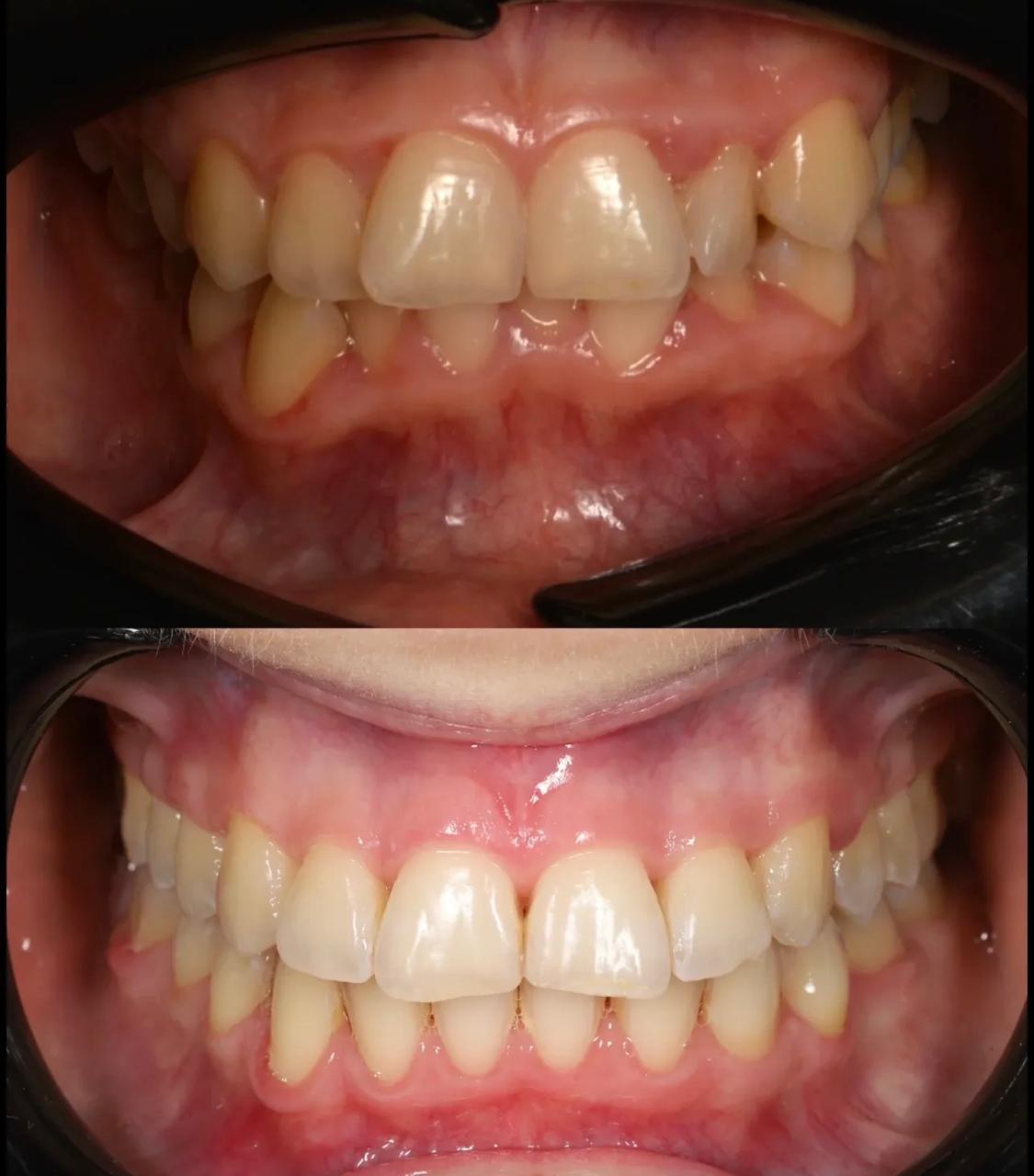 Antes e Depois 2